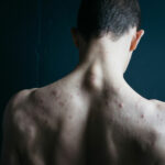 Penyebab dan Cara Mengatasi Jerawat Pada Punggung